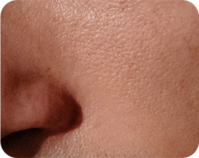 탄력저하모공 이미지